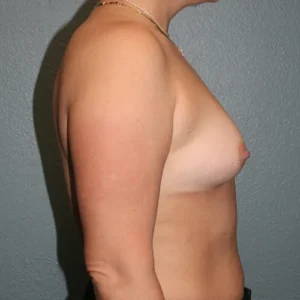 Breast Augmentation