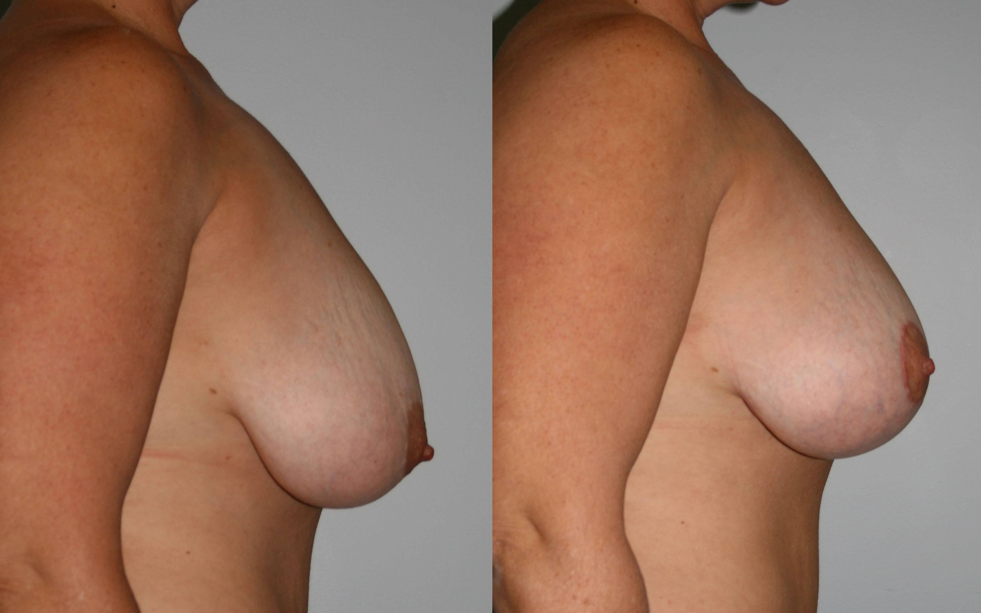 Before and After Breast Lift Photos