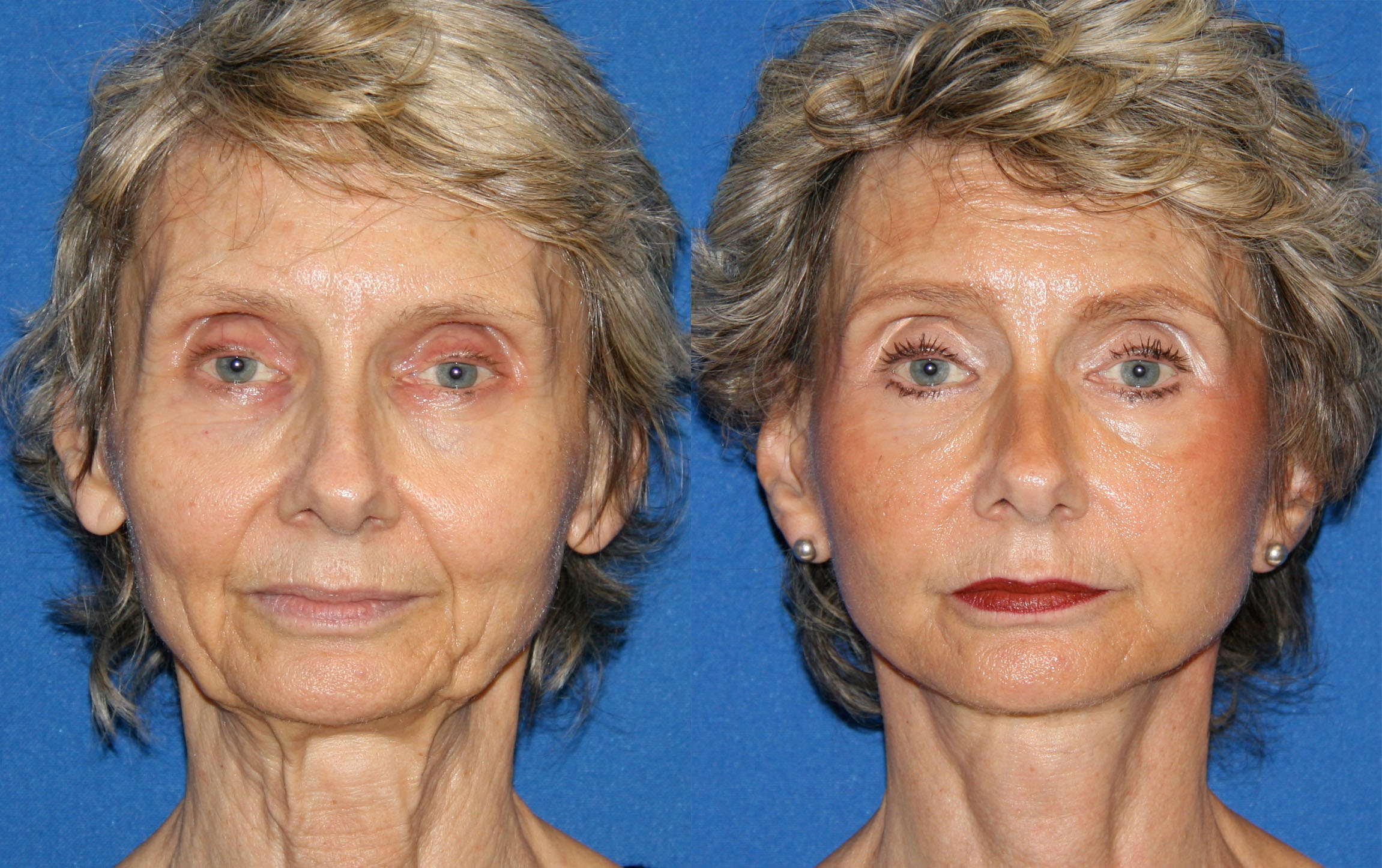 Before and After Facelift Fat transfer