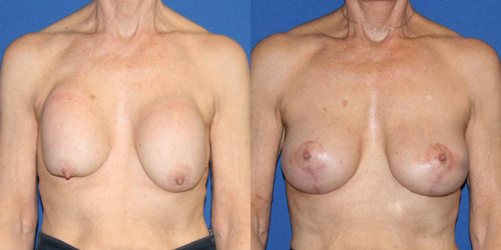 Before and After Revision Breast Augmentation photo