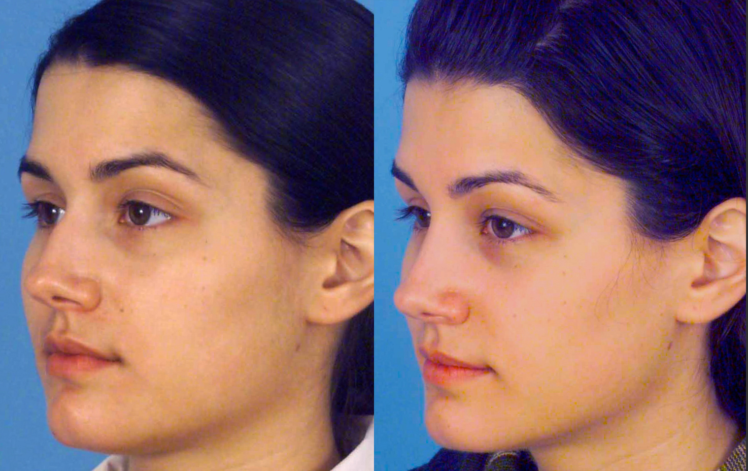 Before and After Rhinoplasty photos