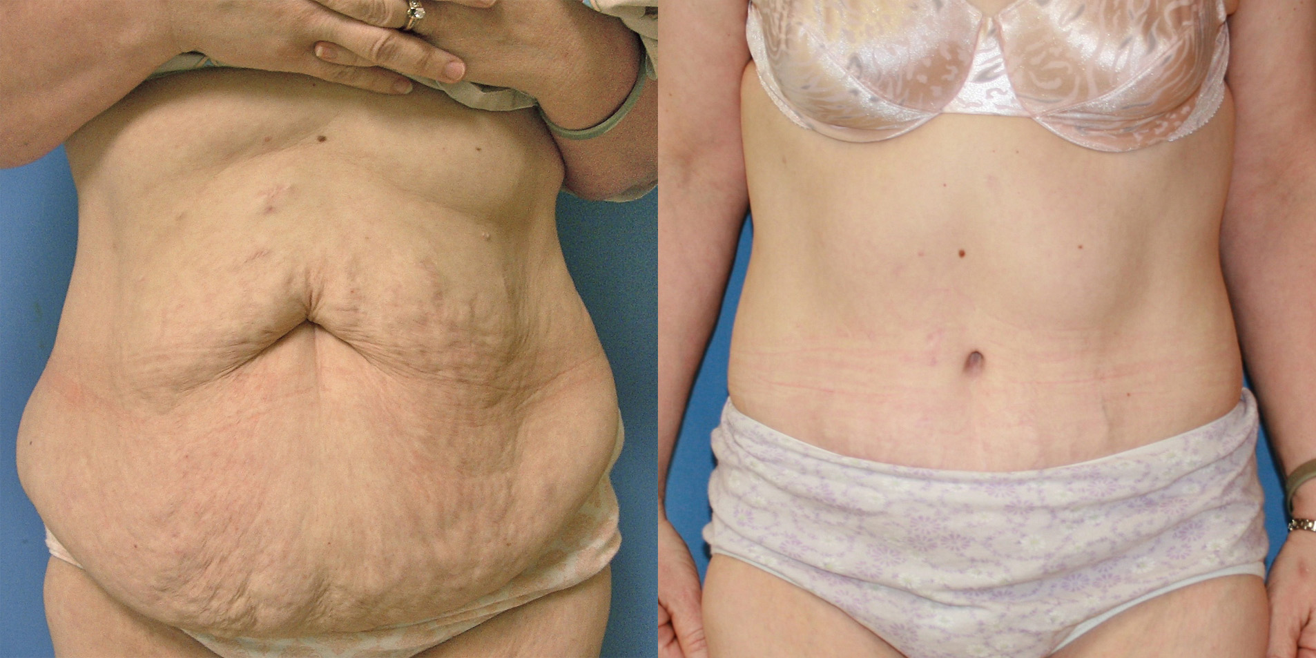 Before and After Tummy Tuck Abdominoplasty