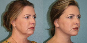 Facelift San Diego