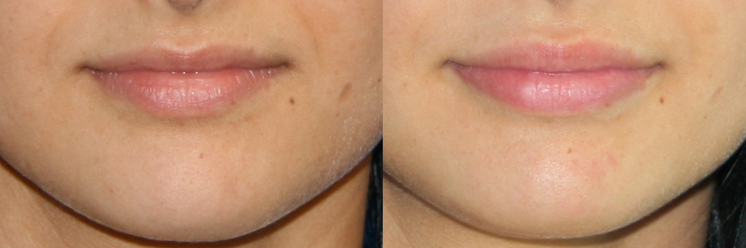 Lip augmentation Juvederm Ultra