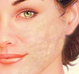 Scar Revision 2 Scar Treatment Discoloration