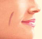 Scar Revision 5 Scar Treatment Hypertropic