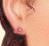 Scar Revision 3 Scar Treatment Keloids