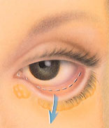 Eyelid Surgery (Blepharoplasty) 5 blepharoplasty-5