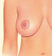 breast_lift-1