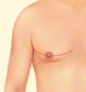 Male Breast Reduction 5 gynecomastia-1
