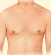 Male Breast Reduction 3 gynecomastia-4
