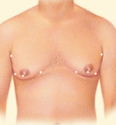 Male Breast Reduction 2 gynecomastia-4