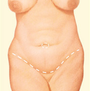Abdominoplasty 6 abominoplastyCOV