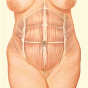abominoplasty-1