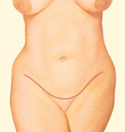Abdominoplasty 9 abominoplasty-3