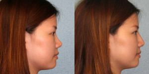 Liquid Rhinoplasty 2 Liquid Rhinoplasty www.drgregpark.com San Diego