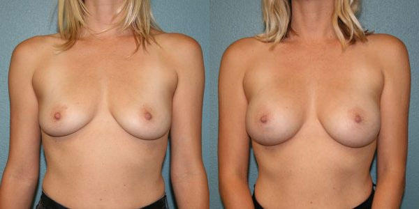 Before and After Breast Augmentation - Mommy Makeover Oceanside