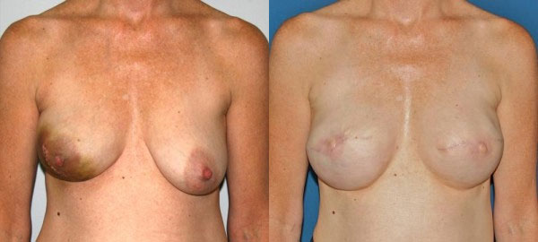 Before and After Breast Reconstruction photos