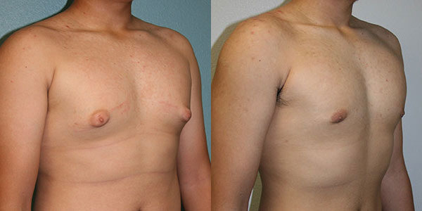 Before and After Male Breast Reduction photos