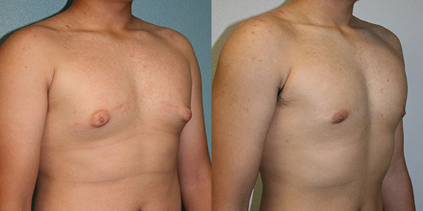 Male Breast Reduction 1 Before and After Male Breast Reduction photos