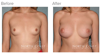Before and After Gummy Bear Breast Implants photos