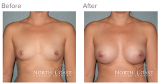 Before and After Gummy Bear Breast Implants photos