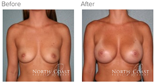 Ideal Breast Implants Surgery Results San Diego