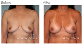 Before and After Ideal Breast Implants photos