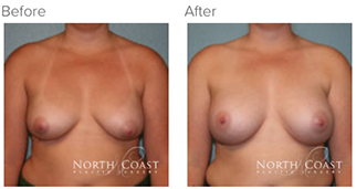 Before and After Ideal Breast Implants photos