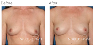 Before and After Natural Breast Augmentation San Diego, Oceanside, CA and Carlsbad, CA