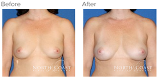 Before and After Natural Breast Augmentation photos