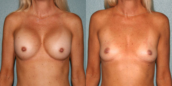 Before and After Breast Implant Removal San Diego, Oceanside, CA and Carlsbad, CA