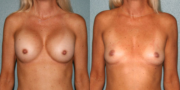 Before and After Breast Augmentation