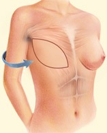 breast_reconstruction-4