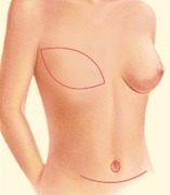 breast_reconstruction-1